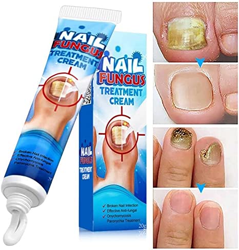 Toenail Fungus Treatment, Maximum Strength Nail Fungus Treatment for Toenail, Toe Fungus Nail Treatment for Finger & Toenail Fungus, Athlete's Foot, Restores Appearance of Discolored or Damaged Nails