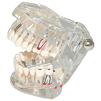Toponechoice Transparent Dental Disease Teeth Model Removable Tooth Teaching Model Tools