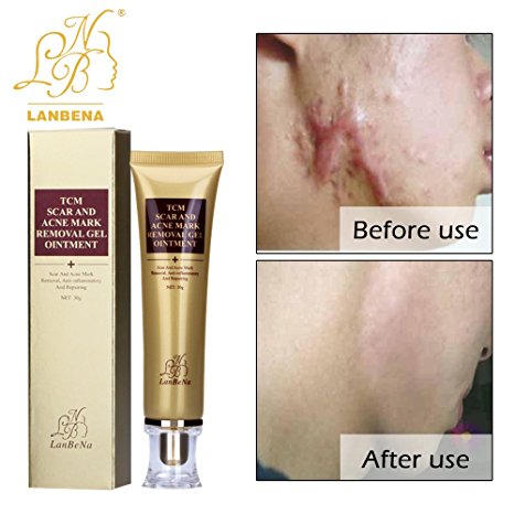 Wisdompark Acne Scar Removal Cream Skin Repair Face Cream Acne Spots Acne Treatment Blackhead Whitening Cream Stretch Marks 30ml (2pcs)