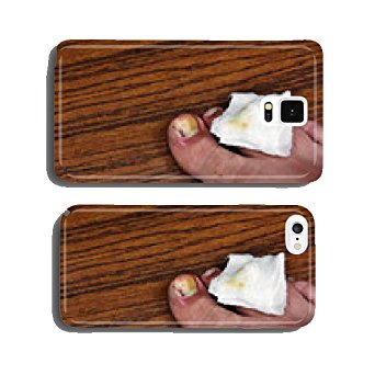 Ingrown toenail with dressing cell phone cover case Samsung S5