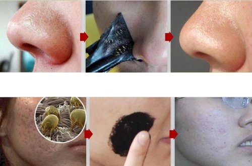 12 Nose Blackhead Removal Strips - Pore Masks