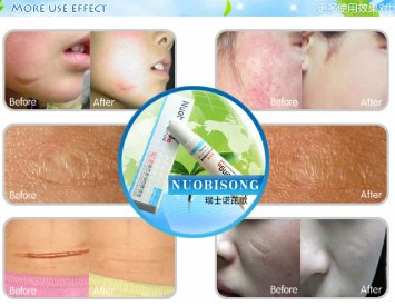 Nuobisong face care acne scar removal cream whitening face cream stretch mark