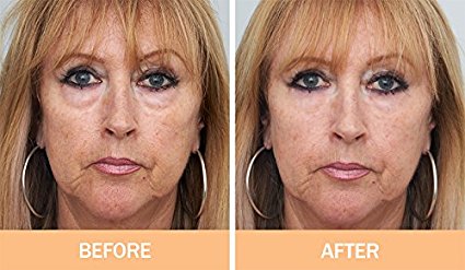 Original Facelift in a bottle. Look 10 years younger instantly. Puffy eyes, forehead, deep lines