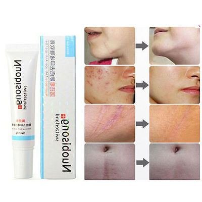 New Bestseller Acne & Blemish Treatments Nuobisong Removal Acne Scar Stretch Marks Cream Treatment Face Care Whitening