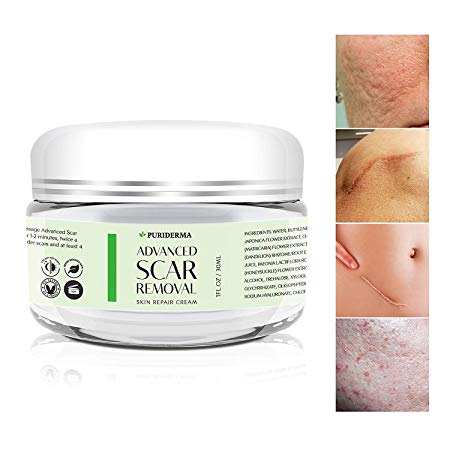 Scar Removal Cream - Advanced Treatment for Face & Body, Old & New Scars from Cuts, Stretch Marks, C-Sections & Surgeries - With Natural Herbal Extracts Formula