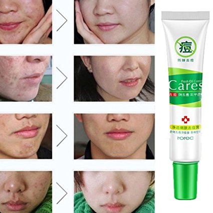 DDLBiz Effective Face Skin Care Cream Acne Spots Scar Removal Blemish Marks Treatment